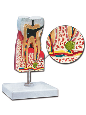 LOWER MOLAR WITH CARIES